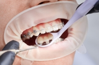 Innowacyjne metody leczenia ortodontycznego